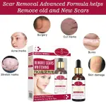 Aichun Beauty Removal Body Scar Serum