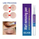 Eelhoe Wart Removing Pen