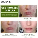 Sodsnie Centella Oligopeptide Acne Serum