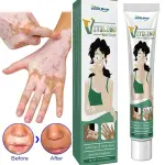 South Moon Vitiligo Relief Cream