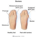 Toe Separator Hallux Valgus
