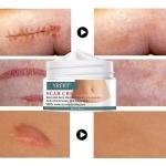YRFKT Acne Stretch Scar Cream